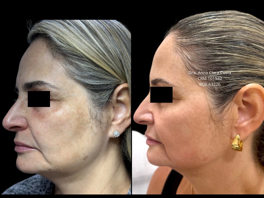 Resultado cl&iacute;nico melasma — perfil 3/4
