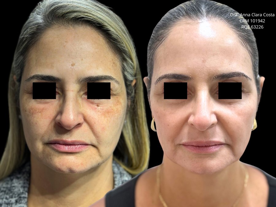 Resultado cl&iacute;nico melasma — vista frontal